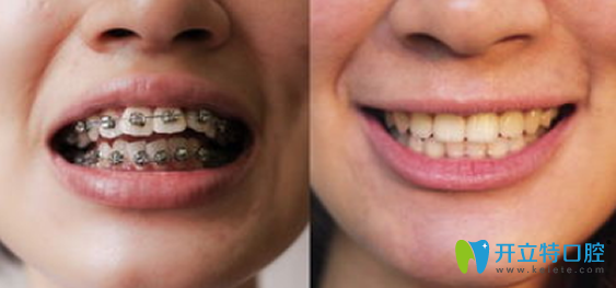 牙齒矯正前后對比圖