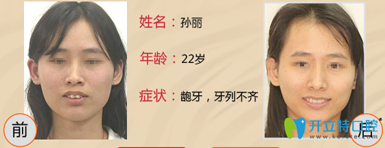 王亞東22歲女性齙牙矯正案例前后效果對比圖 王亞東22歲女性齙牙矯正案例前后效果對比圖