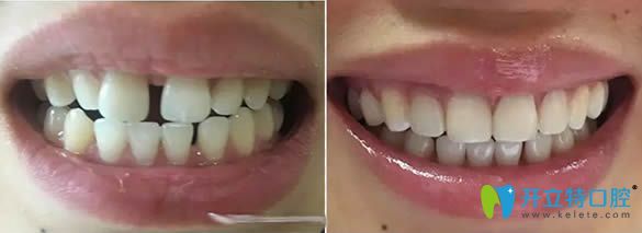 牙齒樹脂貼面修補牙縫案例對比圖