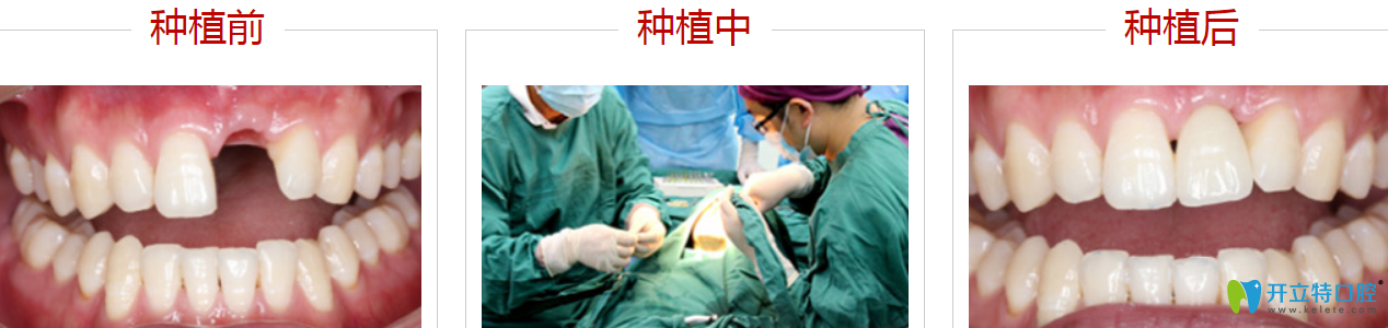 深圳哪里種牙比較好？來看格倫菲爾種植牙案例