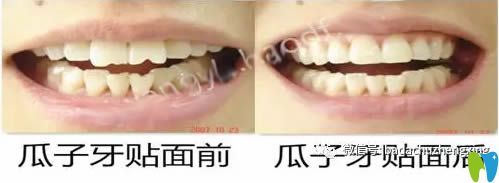 瓜子牙修復前后照片