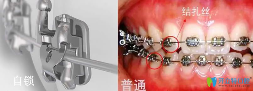 自鎖托槽矯正一萬(wàn)貴嗎？自鎖托槽比金屬托槽好在哪里？