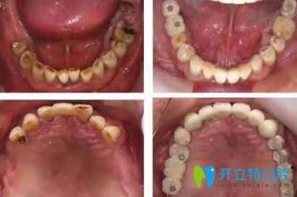 <!--<i data=20240703-sp></i>-->恒愿齒科劉奎恒愿速生牙效果對比圖