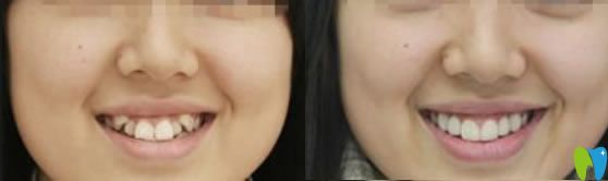 30歲虎牙矯正牙齒案例及前后對(duì)比照