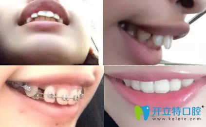 <!--<i data=20240703-sp></i>-->恒愿齒科吳鵬齙牙矯正案例圖 <!--<i data=20240703-sp></i>-->恒愿齒科吳鵬齙牙矯正案例圖