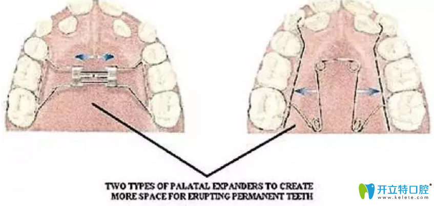 腭擴(kuò)張器（上頜擴(kuò)張器）