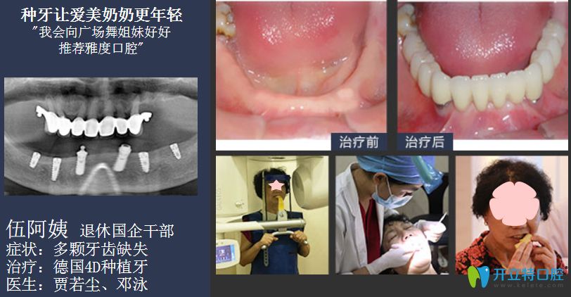 廣州種植牙價格表,看廣州穗華/柏德/德倫等排名前10醫(yī)院收費
