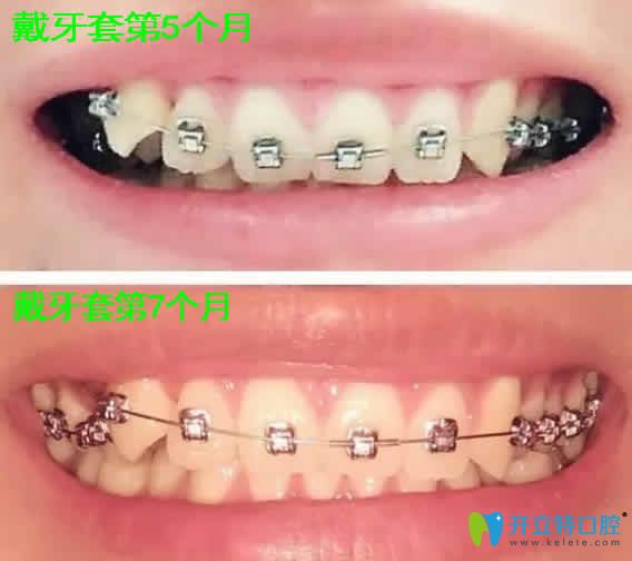 我在天津瑞金口腔做牙齒矯正第3和第7個月照片
