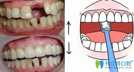 種植牙術(shù)后如何護(hù)理