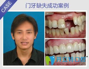 種植牙前后對比圖