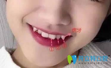 談虎牙矯正好還是拔除好?矯正虎牙(尖牙)價格是多少錢？