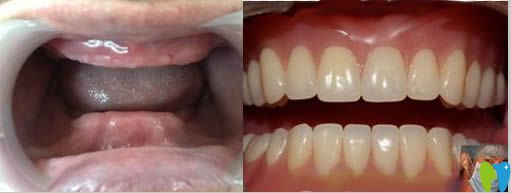 隱形義齒真人佩戴效果對(duì)比圖