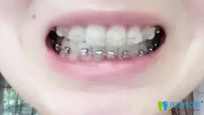 選擇在北京南區(qū)口腔做牙齒正畸戴牙套圖 選擇在北京南區(qū)口腔做牙齒正畸戴牙套圖