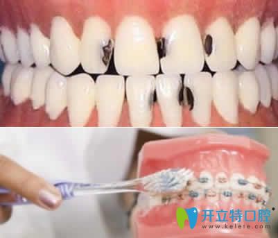 如何有效預(yù)防矯正中出現(xiàn)齲齒