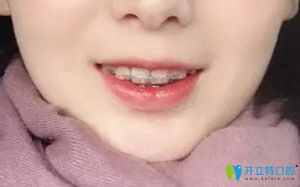 我在北京南區(qū)口腔做了正畸 我在北京南區(qū)口腔做了正畸