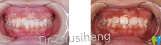 三葉口腔孩子“地包天”早期干預(yù)矯正案例 三葉口腔孩子“地包天”早期干預(yù)矯正案例