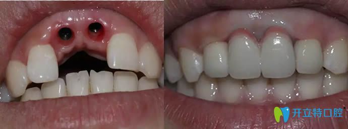 <!--<i data=20240703-sp></i>-->恒愿齒科侯睿種植牙前后效果對比圖