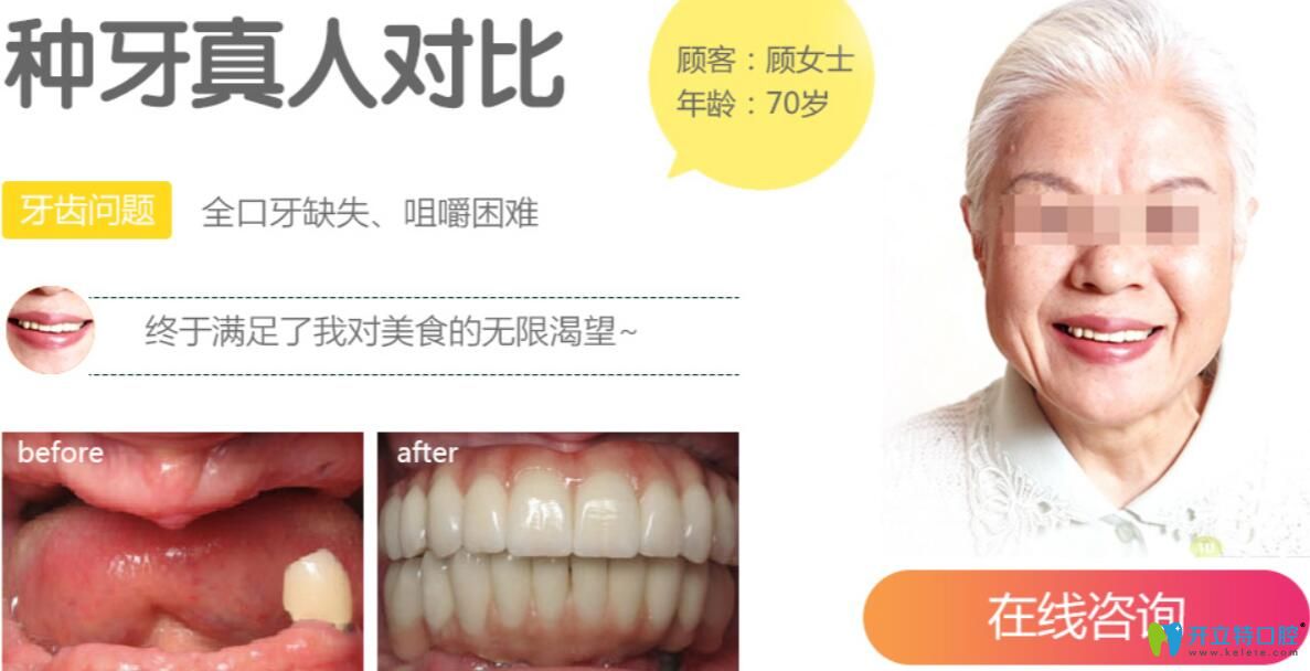 聊城口腔醫(yī)院全口牙種植案例