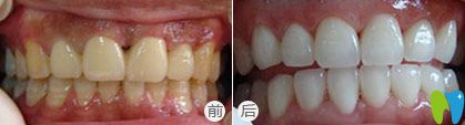 西安優(yōu)典口腔牙齒美白前后對比圖