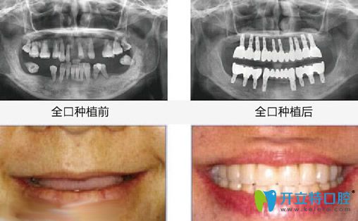 昆明竹子口腔<!--<i data=20240703-sp></i>-->國醫(yī)生全口種植牙案例效果