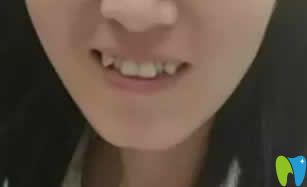 牙齒矯正改變臉型嗎？附我在西安優(yōu)德口腔正畸15個(gè)月效果圖