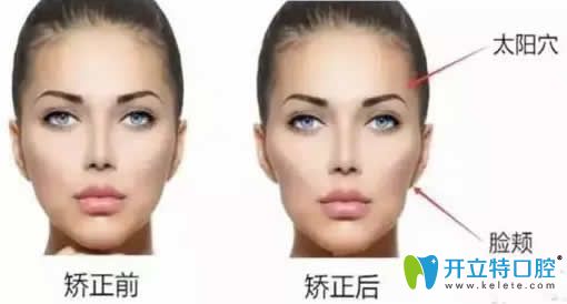 牙套臉是怎么形成的