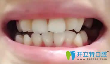 我在竹子口腔做隱形矯正第3個(gè)月照片