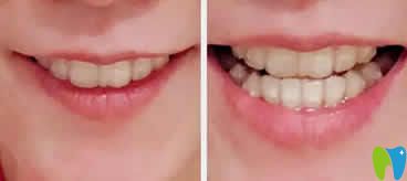 我在昆明竹子口腔戴牙套第9個(gè)月照片