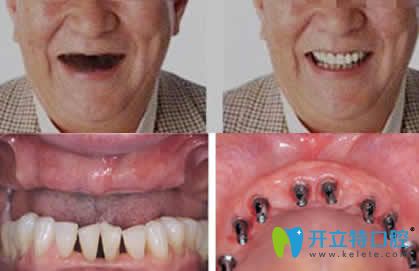昆明竹子口腔全口牙種植效果