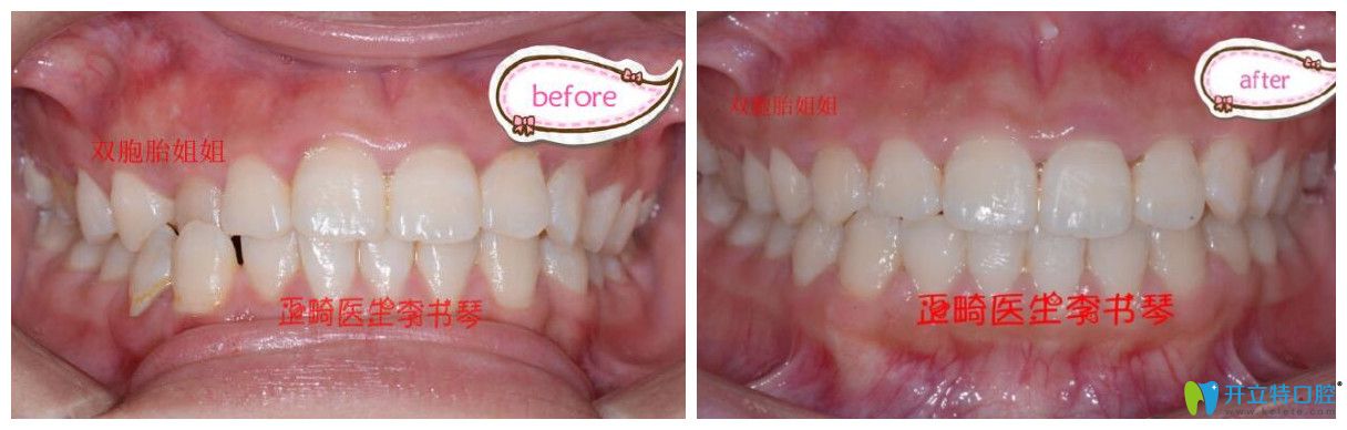 茁悅口腔牙齒錯頜畸形矯正案例效果對比