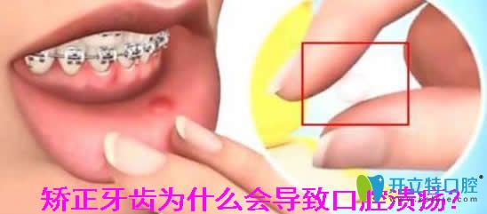 矯正牙齒為什么會(huì)導(dǎo)致口腔潰瘍？正畸口腔潰瘍?cè)趺崔k