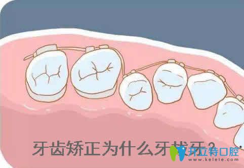 先了解牙齒矯正為什么要拔牙?再看矯正牙齒拔牙有沒有危害
