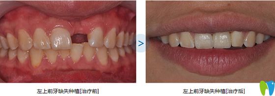 維樂(lè)口腔單顆牙缺失種植效果