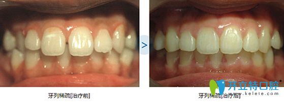 泉州維樂(lè)牙齒稀疏隱形矯正前后對(duì)比圖