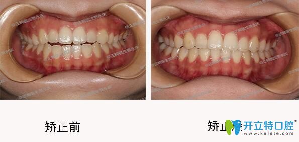 成都口腔哪里正畸好？圣貝口腔牙齒矯正效果來揭曉
