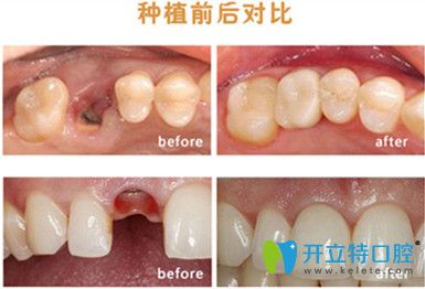 成都圣貝牙科牙齒種植前后對比照 成都圣貝牙科牙齒種植前后對比照