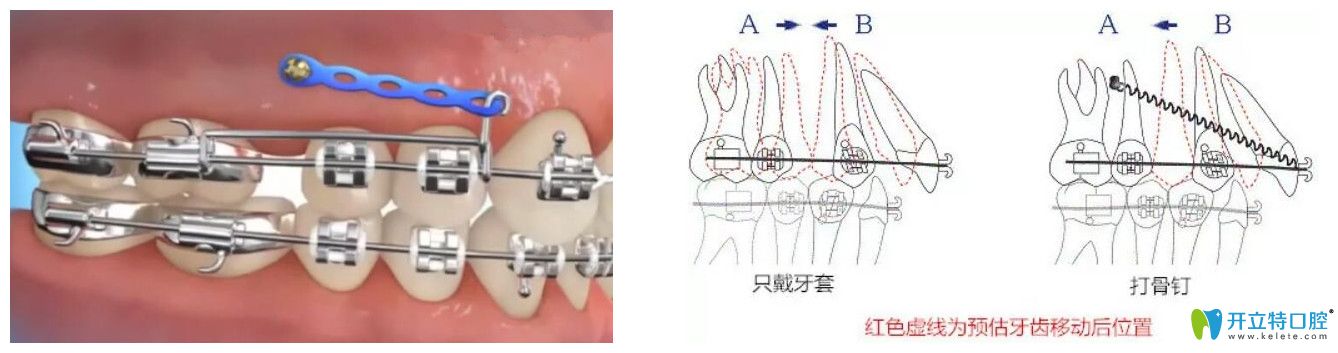 正畸打骨釘疼嗎？牙齒矯正拔骨釘疼不疼