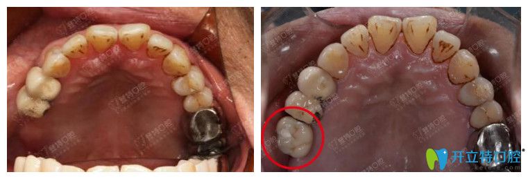 廈門登特口腔為60歲高血壓患者進行種牙案例