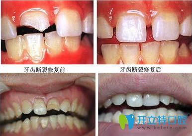 <!--<i data=20240703-sp></i>-->恒愿齒科常紅琴牙體修復(fù)案例效果對(duì)比圖