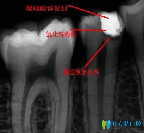 直接蓋髓術拍片圖解