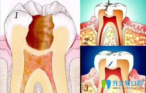 直接蓋髓術和間接蓋髓術的區(qū)別和適應癥有哪些