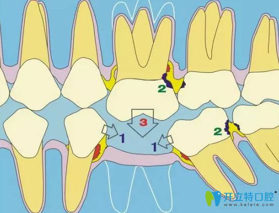 拔牙會(huì)導(dǎo)致旁邊的牙齒松動(dòng)嗎?流傳年輕人不能拔牙是真的嗎