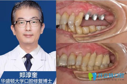 <!--<i data=20240703-sp></i>-->鄭淳奎種植牙案例效果對比圖