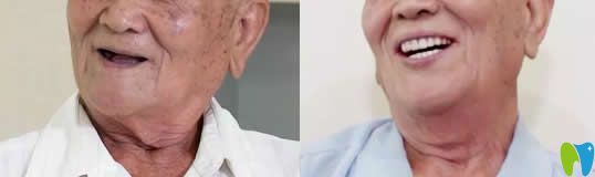 湛江致美口腔全口種植牙前后對(duì)比圖 湛江致美口腔全口種植牙前后對(duì)比圖