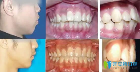 湛江致美口腔齙牙矯正前后對(duì)比圖 湛江致美口腔齙牙矯正前后對(duì)比圖