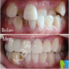 康貝佳口腔牙齒矯正前后對比圖
