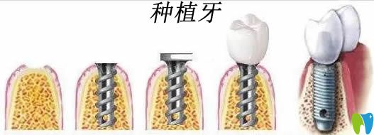 種植牙國產(chǎn)好還是進(jìn)口好?國產(chǎn)種植體和進(jìn)口種植體區(qū)別在哪