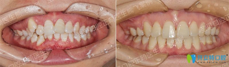 廣州圣貝口腔熊飛牙齒矯正案例 廣州圣貝口腔熊飛牙齒矯正案例