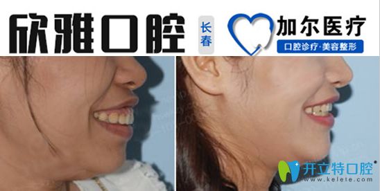 成年人骨性齙牙戴牙套矯正案例圖