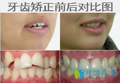 牙齒錯亂矯正前后對比圖